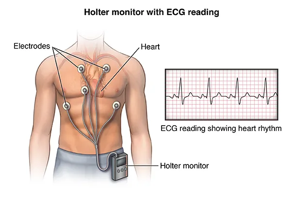 Holter 24 Horas em Imperatriz MA - Prev Consulta